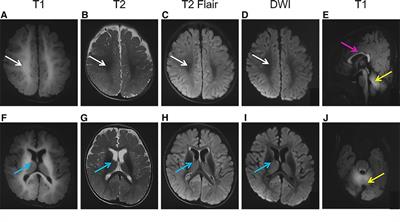 A novel homozygous SLC39A14 variant in an infant with hypermanganesemia and a review of the literature